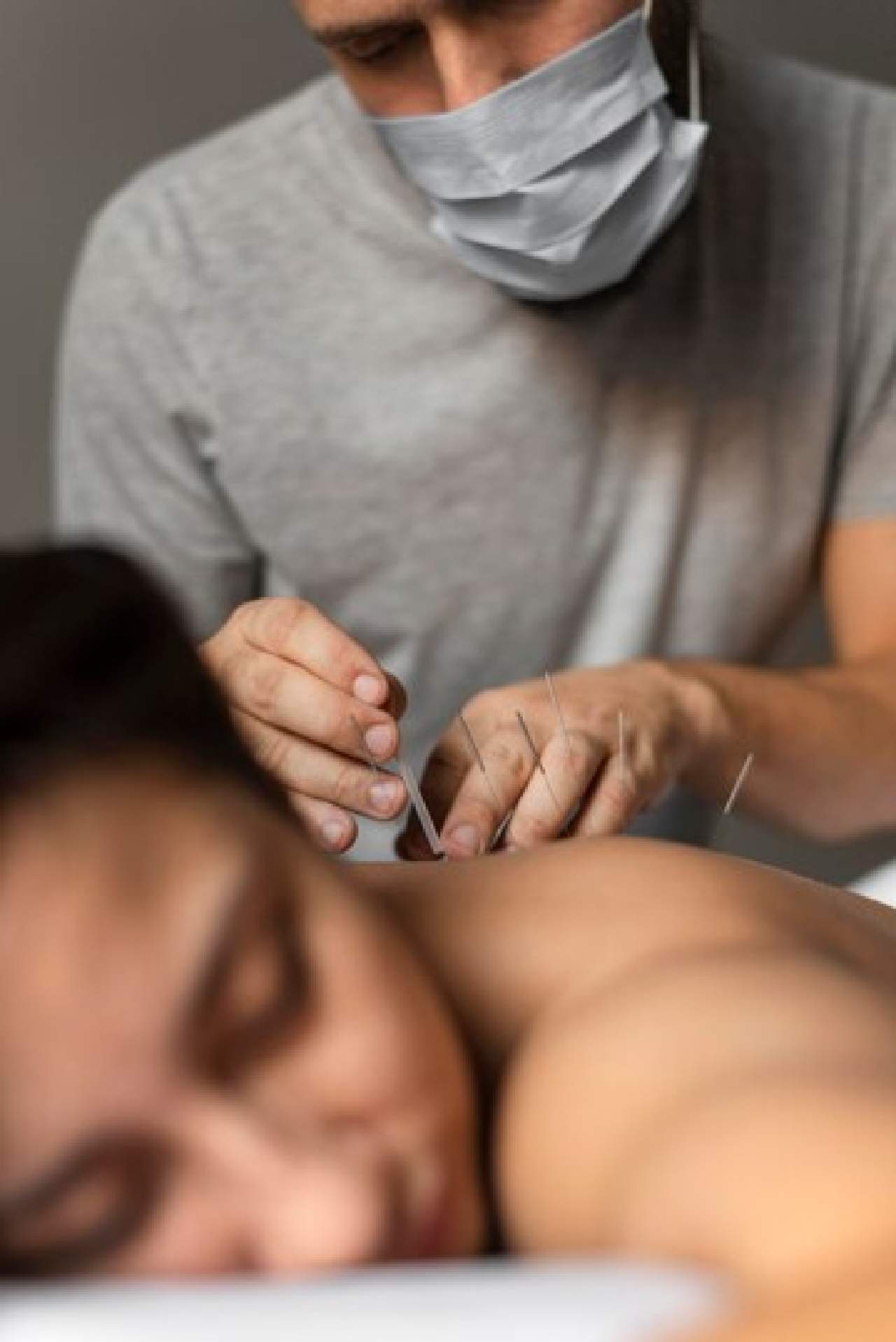 Dry Needling in Epping NSW
